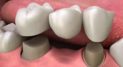 Private: Understanding the Basics About Dental Crowns and Dental Bridges