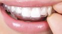 Private: Invisalign and Older Smiles