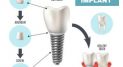 Private: How Dental Implants Changed Dentures Forever