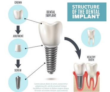 Private: How Dental Implants Changed Dentures Forever